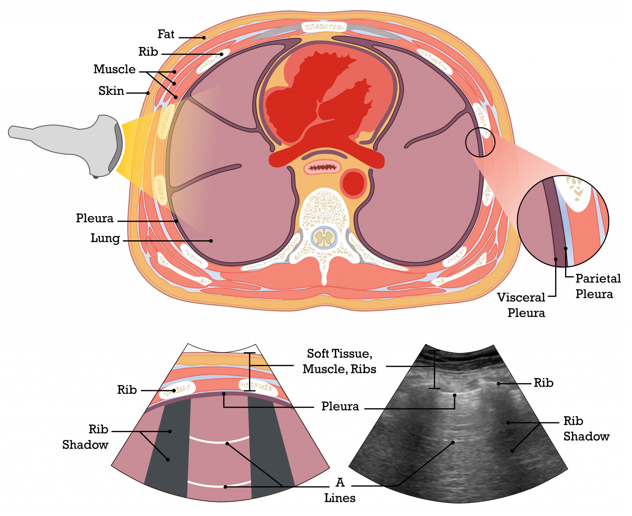 Module 3: Lung & Pleura POCUS → Lung Ultrasound Theory & Principles ...